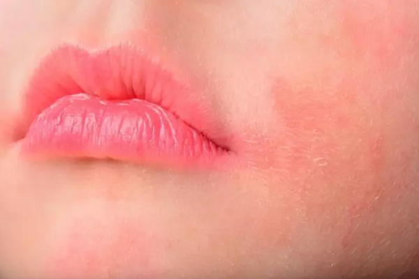 Cerca de 3 millones de mexicanos tienen psoriasis