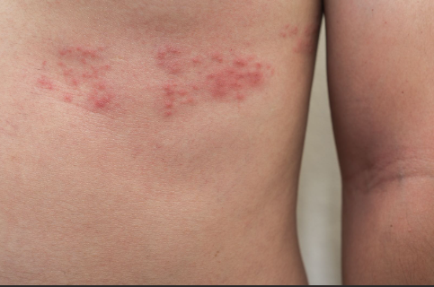 1 de cada 3 adultos mayores de 50 años en México podría desarrollar herpes zóster en su vida